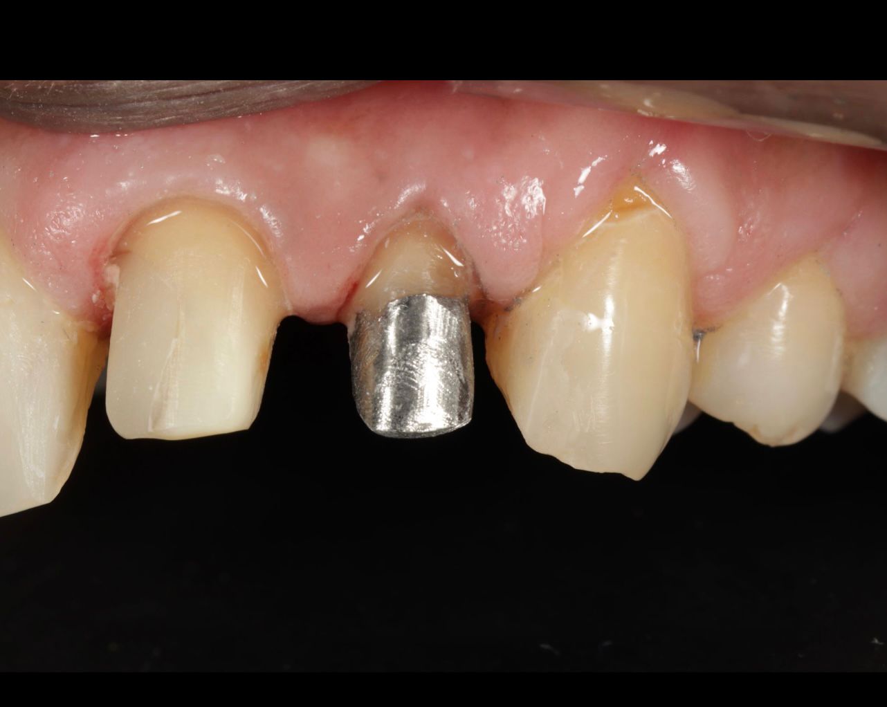 Retreatment of a crowned tooth with post & core build-up and periapical lesion at apollo jbp hospitals