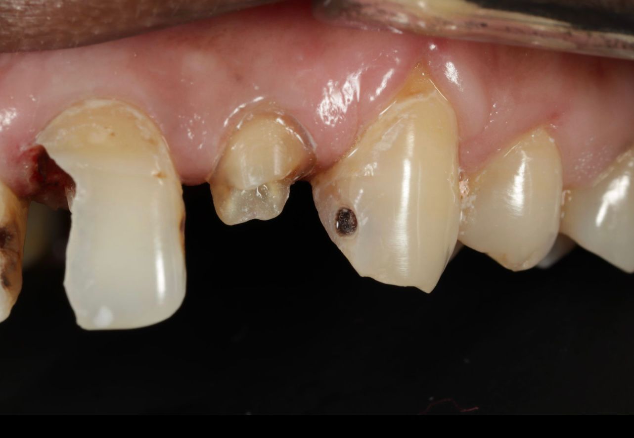 Retreatment of a crowned tooth with post & core build-up and periapical lesion at apollo jbp hospitals