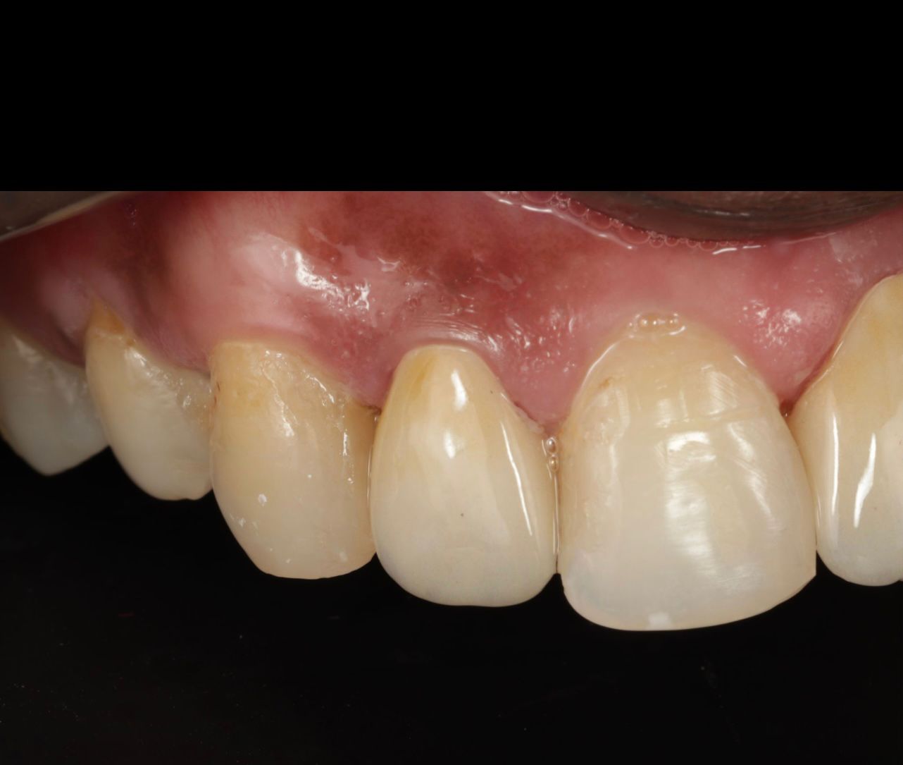 Retreatment of a crowned tooth with post & core build-up and periapical lesion at apollo jbp hospitals