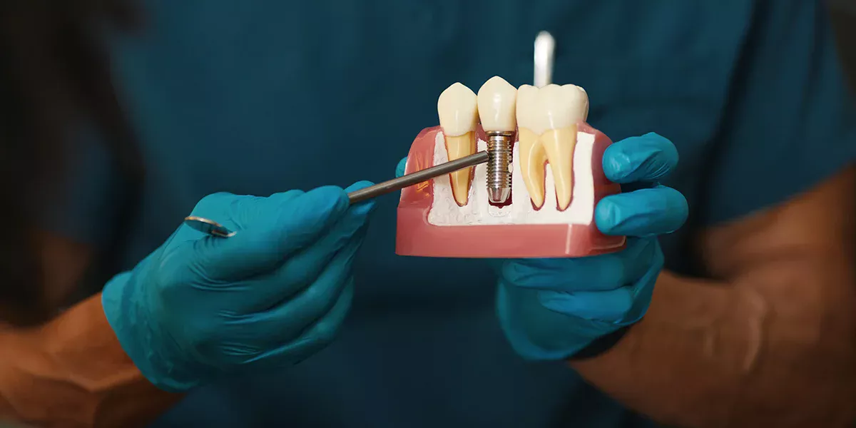 Dental implant in jabalpur at apollo jbp hospitals