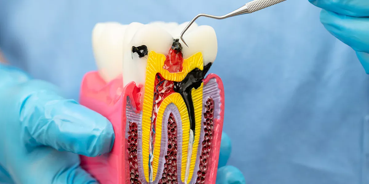 Root canal treatment in jabalpur at apollo jbp hospitals
